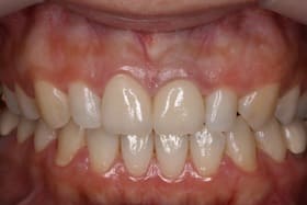 前歯2本オールセラミックス01治療後