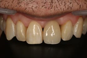 前歯部オールセラミックス＋ダイレクトボンディング02治療後