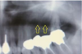 臼歯部インプラント02治療前