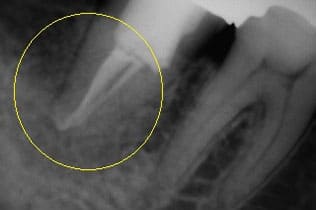 マイクロエンドにより抜歯を回避術後