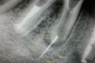 根管内異物除去①（リーマ除去）術前