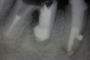 根管内異物除去①（リーマ除去）術後