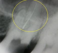 リーマ除去術前