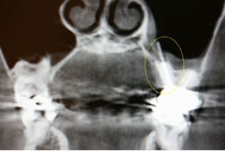 歯が原因で起きる副鼻腔炎術前