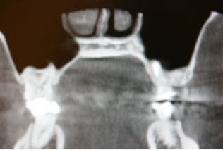 歯が原因で起きる副鼻腔炎術後