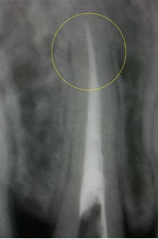 マイクロスコープによる根管治療術後