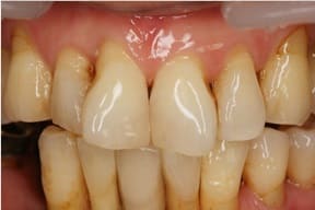 ハイブリットセラミックによるダイレクトボンディング01治療後