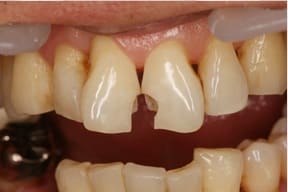 ハイブリットセラミックによるダイレクトボンディング01治療前