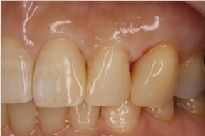 ハイブリットセラミックによるダイレクトボンディング02治療後