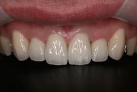 前歯部6本オールセラミックス01治療後
