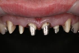 前歯部6本オールセラミックス01治療前