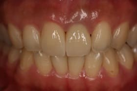前歯部オールセラミックス＋ダイレクトボンディング01治療後