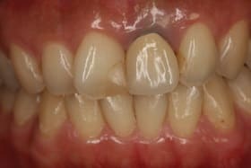 前歯部オールセラミックス＋ダイレクトボンディング01治療前