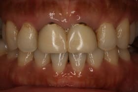 前歯部オールセラミックス＋ダイレクトボンディング03治療前