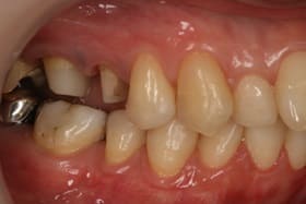 上顎臼歯部オールセラミックス01治療前