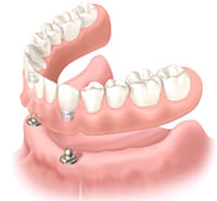 ボールタイプのオーバーデンチャー