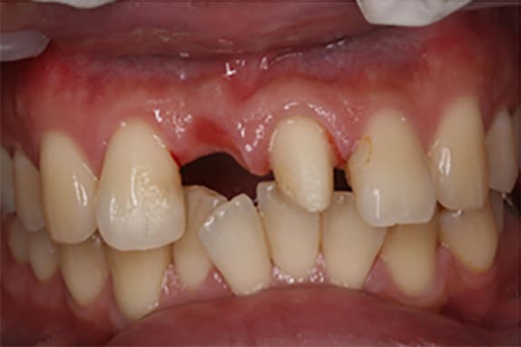前歯部インプラント01治療前