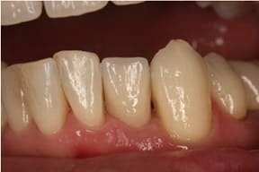 前歯部インプラント02治療後
