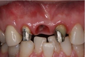 前歯部インプラント03治療前