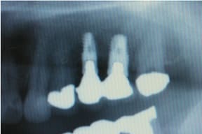 臼歯部インプラント02治療後
