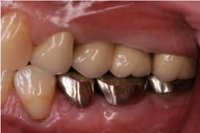 臼歯部インプラント03治療後