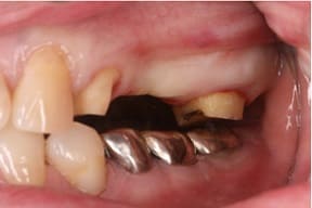 臼歯部インプラント03治療前