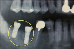 臼歯部インプラント04治療後