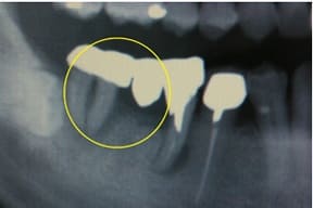 臼歯部インプラント04治療前