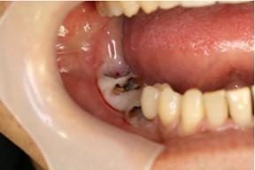 臼歯部インプラント05治療前